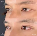 二重埋没 before画像 サムネイル用