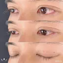 二重埋没 after画像 サムネイル用
