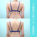 『 二の腕脂肪吸引 』ガッツリ吸引でもタルミなく美しく仕上げる匠の熟練技！ before画像 サムネイル用