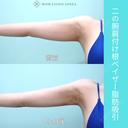 『 二の腕脂肪吸引 』ガッツリ吸引でもタルミなく美しく仕上げる匠の熟練技！ 120日後 サムネイル用