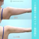 『 二の腕脂肪吸引 』ガッツリ吸引でもタルミなく美しく仕上げる匠の熟練技！ 120日後 サムネイル用