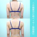 細めの方でも、二の腕と腰からガッツリ吸引、コンデンスリッチ豊胸でお胸もサイズアップ可能 180日後 サムネイル用