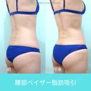 細めの方でも、二の腕と腰からガッツリ吸引、コンデンスリッチ豊胸でお胸もサイズアップ可能 180日後 サムネイル用
