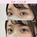 涙袋ヒアルロン酸 before画像 サムネイル用