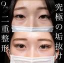 二重埋没 before画像 サムネイル用