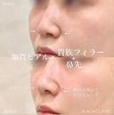 加賀ヒアル×貴族フィラー＋鼻コルメラストラット法 after画像 サムネイル用