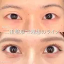 MD式たるみ取り併用全切開二重 before画像 サムネイル用