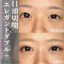 印象的な目元へ✨目頭切開xエレガントダブル＋ before画像 サムネイル用