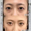 東京秘密クリニックのDr佐々木院長による目の下のクマ取り(下眼瞼脱脂術) after画像 サムネイル用