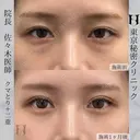 クマ取り(下眼瞼脱脂術)＋目の上の脂肪取り+二重埋没３点 after画像 サムネイル用