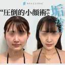 ３D脂肪吸引(頬・顎下)/糸リフト/エラボトックス/二の腕の脂肪吸引（二の腕・肩） before画像 サムネイル用