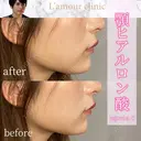 顎ヒアルロン酸 after画像 サムネイル用
