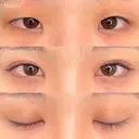 目頭切開＋二重埋没 90日後 サムネイル用