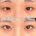 目頭切開＋二重埋没 90日後 サムネイル用