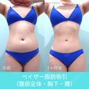 圧倒的自信があります！ 高い技術力の脂肪吸引で腹・腰回りをしっかりクビレさせます！ 90日後 サムネイル用
