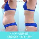 圧倒的自信があります！ 高い技術力の脂肪吸引で腹・腰回りをしっかりクビレさせます！ 90日後 サムネイル用
