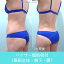 圧倒的自信があります！ 高い技術力の脂肪吸引で腹・腰回りをしっかりクビレさせます！ 90日後 サムネイル用