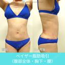 圧倒的自信があります！ 高い技術力の脂肪吸引で腹・腰回りをしっかりクビレさせます！ 1日後 サムネイル用