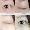 二重埋没法 before画像 サムネイル用