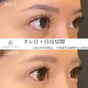タレ目形成（埋没）+目尻切開 after画像 サムネイル用