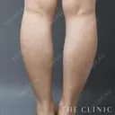 ふくらはぎのベイザー脂肪吸引 before画像 サムネイル用