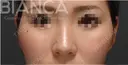 【ヒアルロン酸で鼻先〜鼻筋を整える】 before画像 サムネイル用