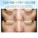 【40代女性・目の下のクマをどう治す？】ハムラ法+α＆プレミアムPRP補正（3年後） before画像 サムネイル用