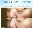 【40代女性・目の下のクマをどう治す？】ハムラ法+α＆プレミアムPRP補正（3年後） after画像 サムネイル用
