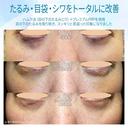 【40代女性・目の下のクマをどう治す？】ハムラ法+α＆プレミアムPRP補正（3年後） after画像 サムネイル用