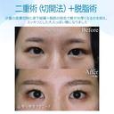 【20代女性・スッキリした二重まぶたへ】二重術（切開法）＋脱脂術（2年後） before画像 サムネイル用