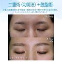 【20代女性・スッキリした二重まぶたへ】二重術（切開法）＋脱脂術（2年後） after画像 サムネイル用