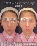 糸リフトでほうれい線すっきり・口元も・たるみケア before画像 サムネイル用
