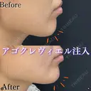 顎ヒアルロン酸 0日後 サムネイル用