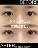 クマ取り＆涙袋ヒアル！ 30日後 サムネイル用
