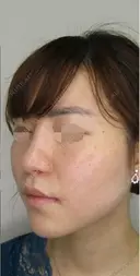 メーラーファット+ジョールファット除去 after画像 サムネイル用