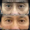 窪み目改善！とみー先生によるコンデンスリッチ脂肪注入 before画像 サムネイル用