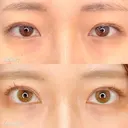 MD式たるみ取り併用全切開+眼瞼下垂＋MD式目頭切開 before画像 サムネイル用