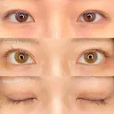 MD式たるみ取り併用全切開+眼瞼下垂＋MD式目頭切開 180日後 サムネイル用
