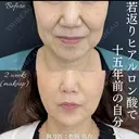 ヒアルロン酸 after画像 サムネイル用