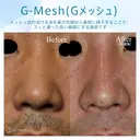 【30代男性・Gメッシュで綺麗な鼻筋を手に入れる！！】Gメッシュ（術直後） before画像 サムネイル用