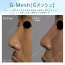 【30代男性・Gメッシュで綺麗な鼻筋を手に入れる！！】Gメッシュ（術直後） 0日後 サムネイル用