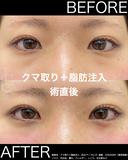 術直後からこの仕上がり！クマ治療もやっぱりやはし before画像 サムネイル用
