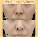 薄いシミやくすみを改善！フォトトリプル✨ 150日後 サムネイル用