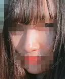鼻の手術 before画像 サムネイル用
