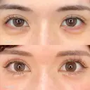 MD式目頭切開 before画像 サムネイル用