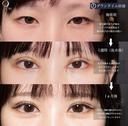 二重埋没 before画像 サムネイル用