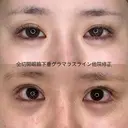 全切開＋眼瞼下垂修正＋グラマラスライン結膜切開（全て他院修正） 90日後 サムネイル用