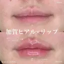 加賀ヒアル×リップ after画像 サムネイル用
