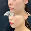 小顔脂肪吸引(あご下) before画像 サムネイル用