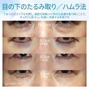 【40代女性・理想のオージーカーブをつくる】ハムラ法+α 単独（2年後） after画像 サムネイル用